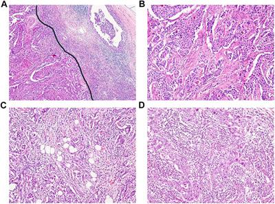 Immunohistochemical Expressions of Senescence-Associated Secretory Phenotype and Its Association With Immune Microenvironments and Clinicopathological Factors in Invasive Breast Cancer